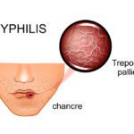 Syphilis, Congenital