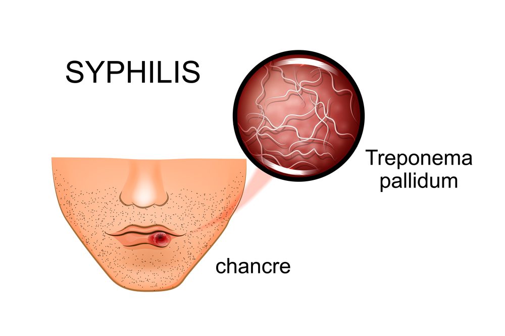 Syphilis Congenital Overview Causes Symptoms Treatment Illness Com