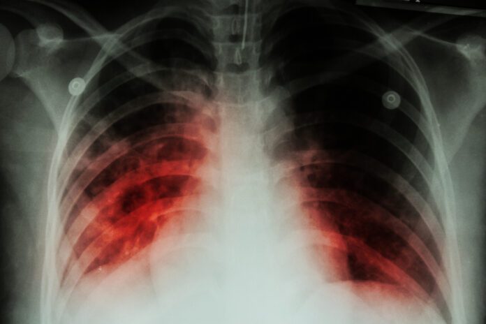 Pulmonary Tuberculosis