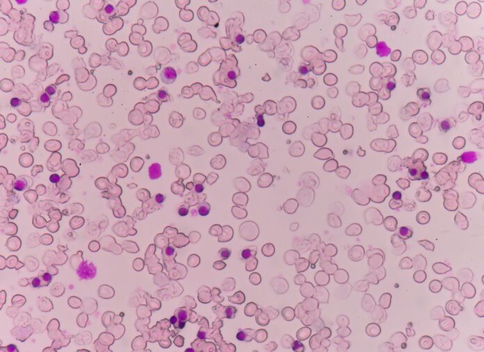 Thalassemia