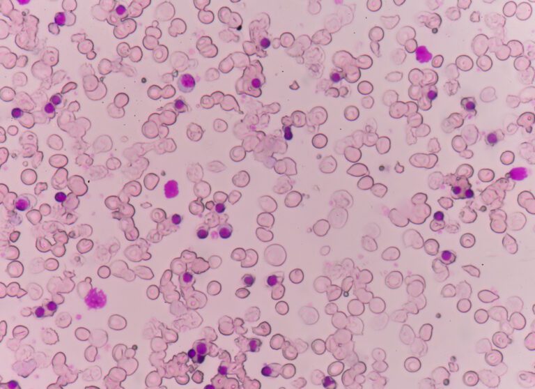 Mediterranean Anemia Illness Com   Thalassemia 768x558 