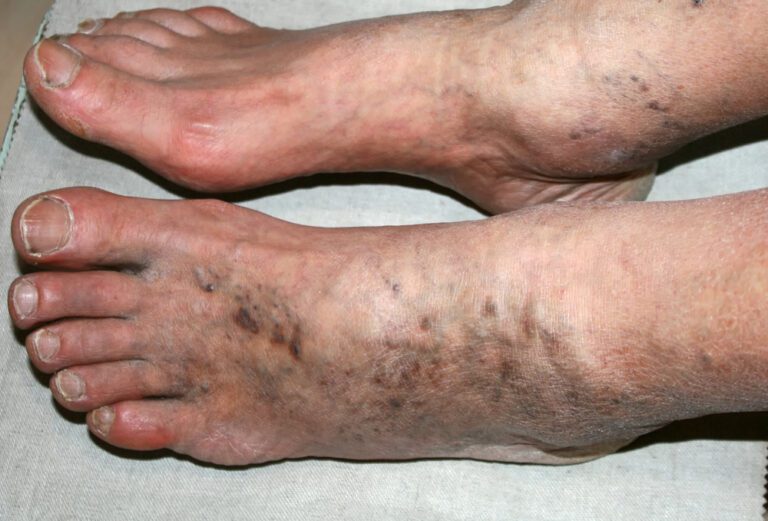 Buerger Disease