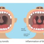 Sore Throat - Tonsillitis