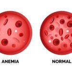 Bone Marrow Failure – Aplastic Anemia