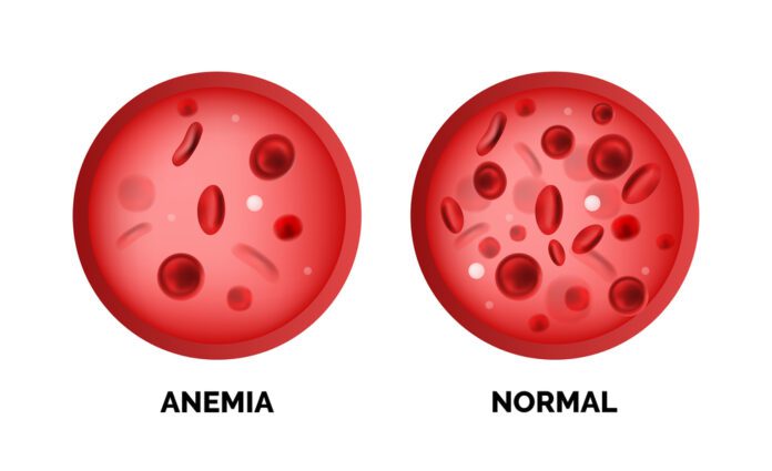 Bone Marrow Failure – Aplastic Anemia