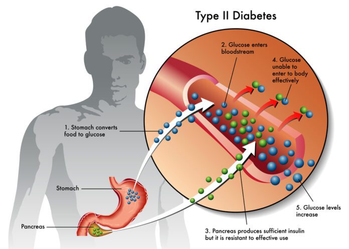 Type 2 Diabetes