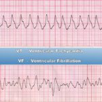 Ventricular Tachycardia