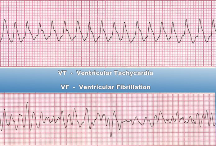 Ventricular Tachycardia