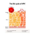 Genital Warts (Human Papillomavirus)