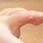 Warts And Plantar Warts