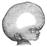 Water On The Brain (Hydrocephalus)