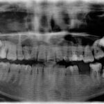 Impacted Tooth