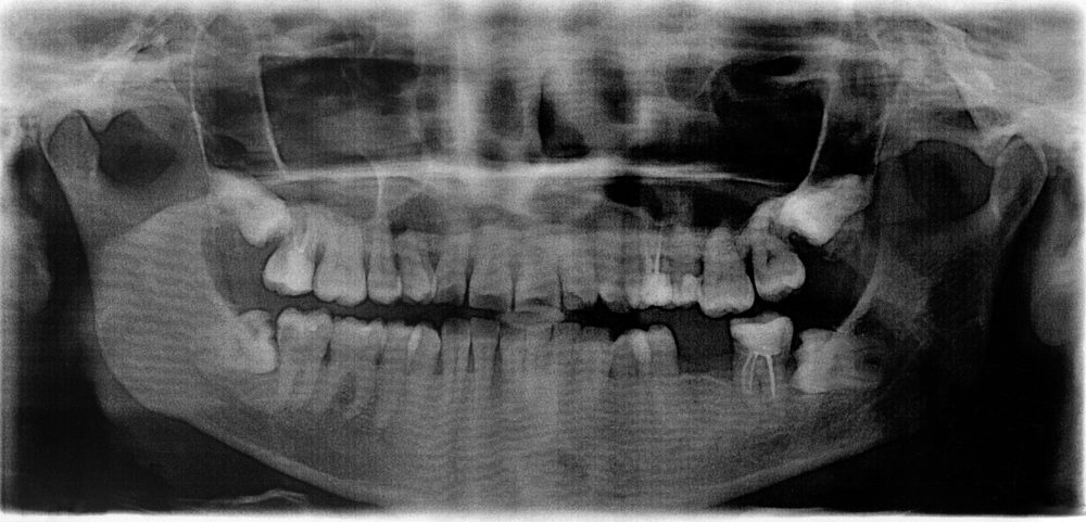 Impacted Tooth : Overview, Causes, Symptoms, Treatment - illness.com