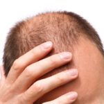 Alopecia Totalis