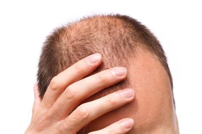 Alopecia Totalis