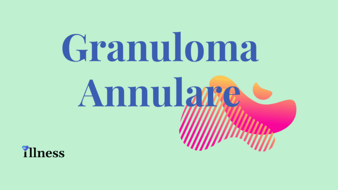 Granuloma Annulare