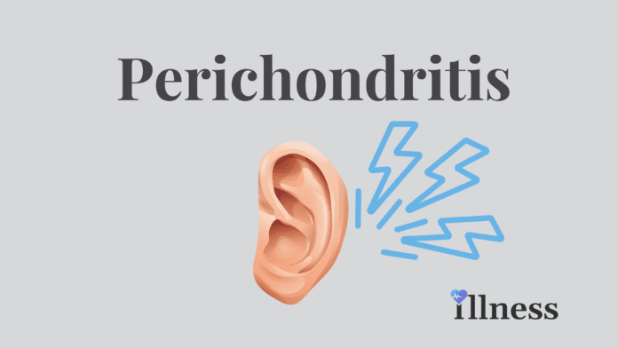 Perichondritis