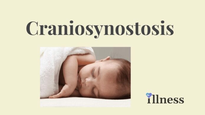 Craniosynostosis