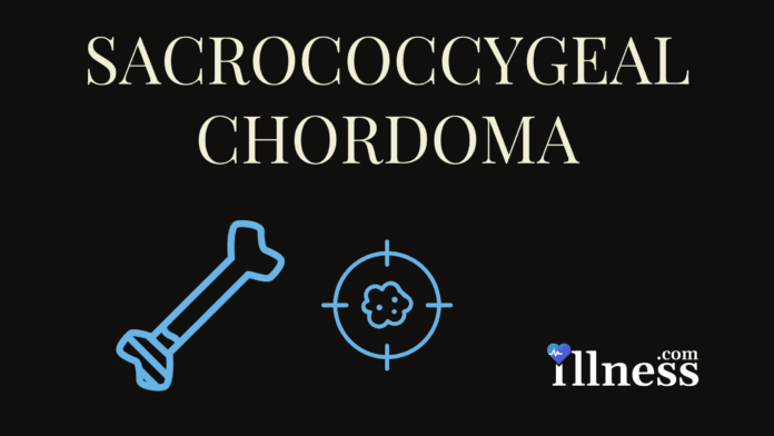 Sacrococcygeal Chordoma