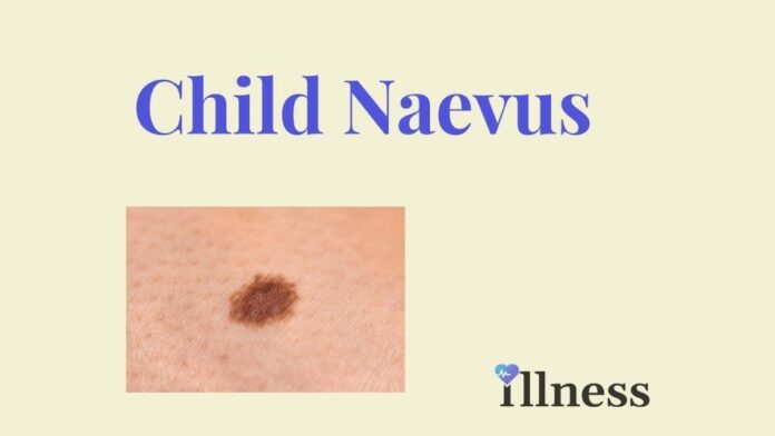 Child Naevus