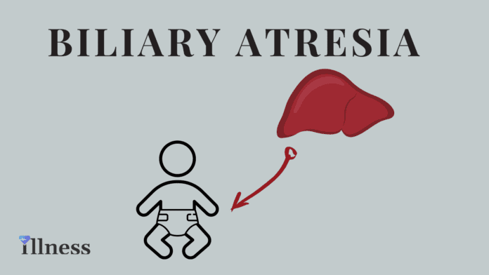 Biliary Atresia, Extrahepatic