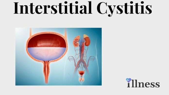 Interstitial Cystitis (IC)