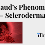 Scleroderma