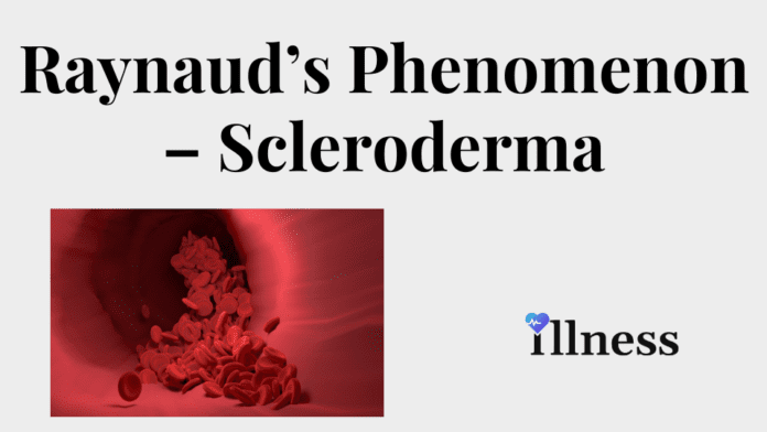 Scleroderma