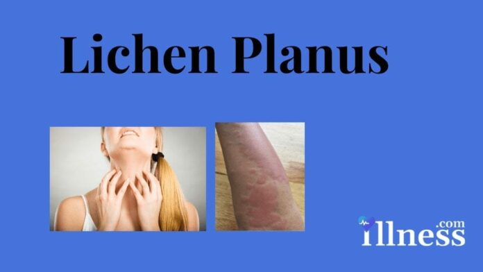 Lichen Planus