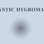 Cystic Hygroma