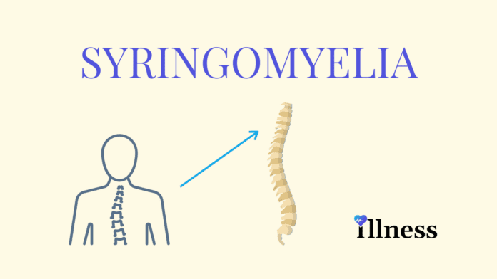 Syringomyelia