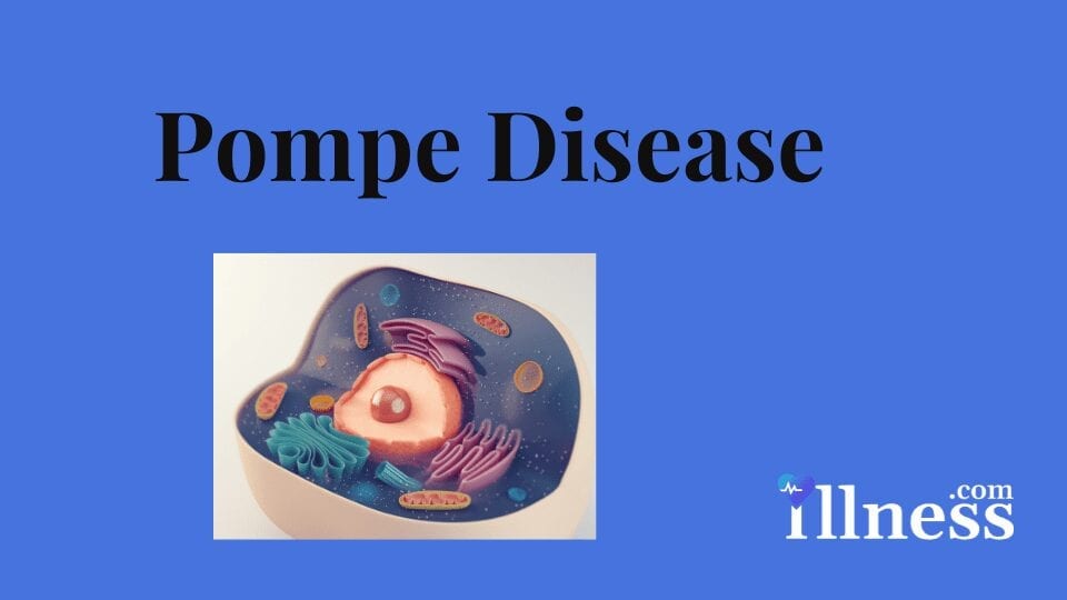 Pompe Disease : Overview, Causes, Symptoms, Treatment - illness.com