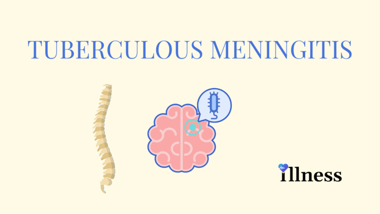 Tuberculous Meningitis : Overview, Causes, Symptoms, Treatment ...