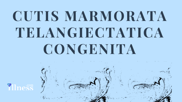 Cutis Marmorata Telangiectatica Congenita