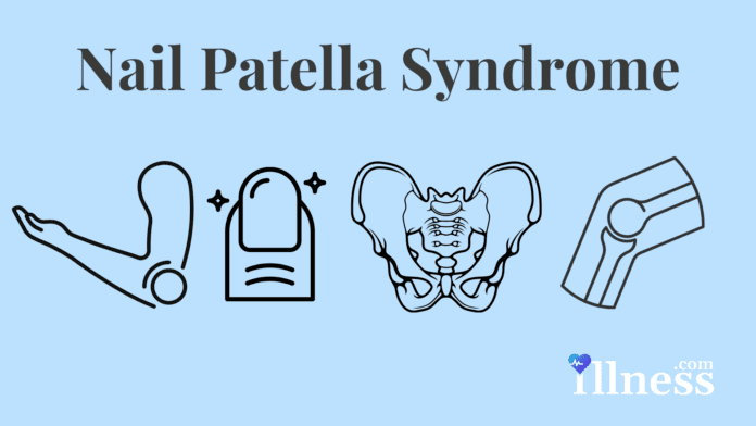 Nail Patella Syndrome