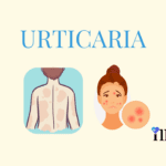 Urticaria - Hives