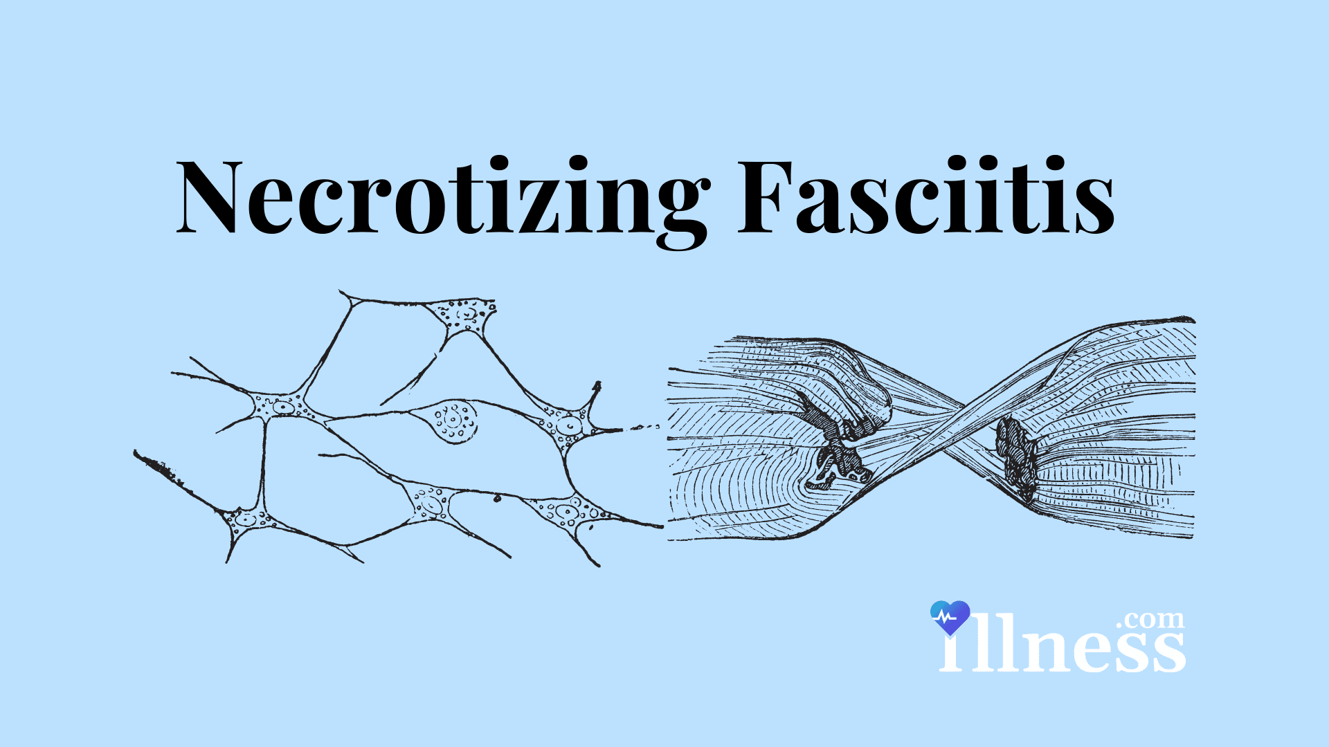 Necrotizing Soft Tissue Infection Overview Causes Symptoms Necrotizing Soft Tissue Infection Overview Causes Symptoms