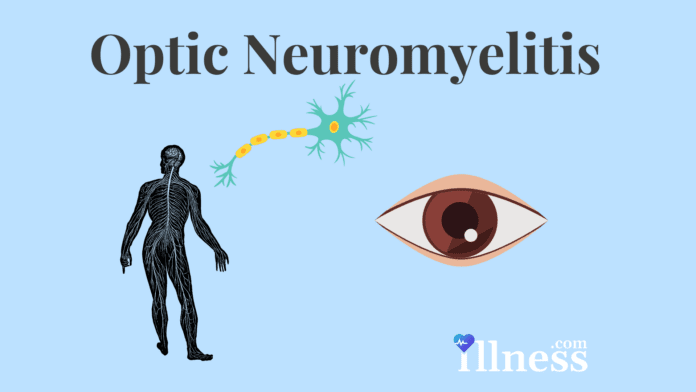 Optic Nerve Atrophy