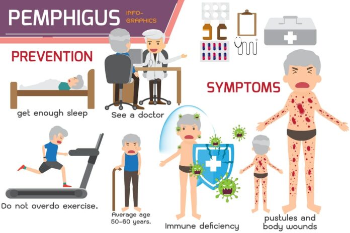 Brazilian Pemphigus Foliaceus