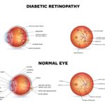 Diabetic Eye Disease