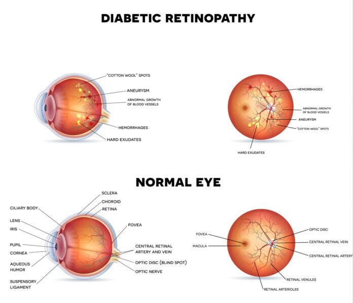 Diabetic Eye Disease