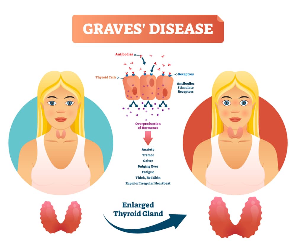 Grave s Disease Overview Causes Symptoms Treatment Illness