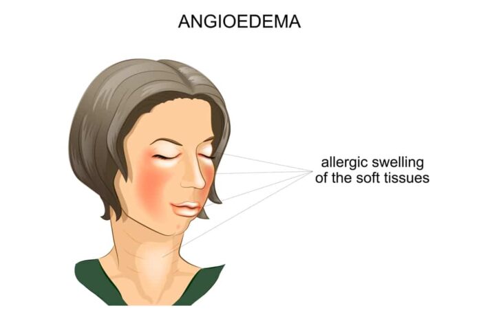 Hereditary Angioneurotic Edema