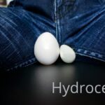 Hydrocele