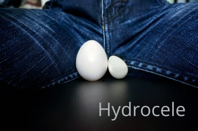 Hydrocele