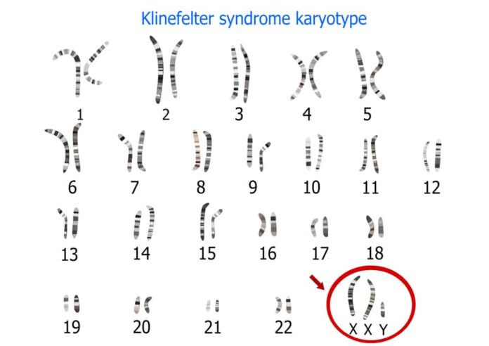 Klinefelter Syndrome