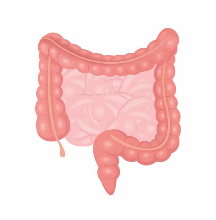 Malignant Large Bowel Tumor