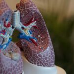 Malignant Pleura Mesothelioma (MPM)