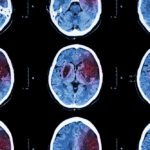 Transient Ischemic Attack (TIA)