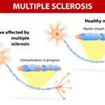 Multiple Sclerosis Treatment: Types Of Treatment & Benefits